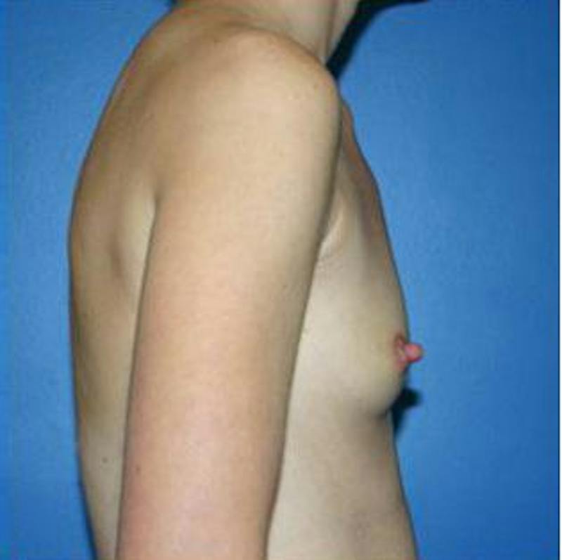 Breast Augmentation Before & After Gallery - Patient 351514 - Image 3