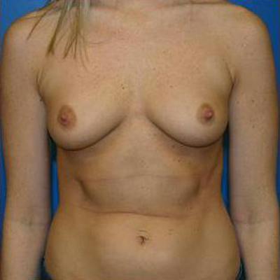 Breast Augmentation Before & After Gallery - Patient 930629 - Image 1
