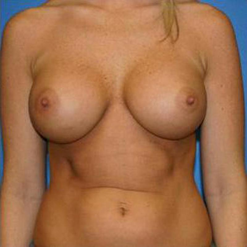 Breast Augmentation Before & After Gallery - Patient 930629 - Image 2