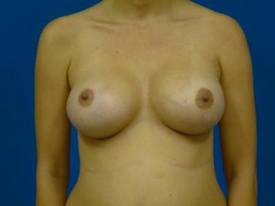 Breast Augmentation Before & After Gallery - Patient 177129 - Image 2