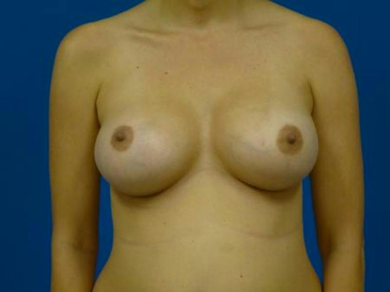 Breast Augmentation Before & After Gallery - Patient 177129 - Image 2