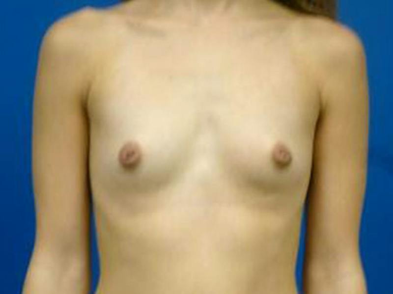Breast Augmentation Before & After Gallery - Patient 292658 - Image 1