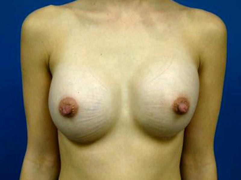 Breast Augmentation Before & After Gallery - Patient 292658 - Image 2