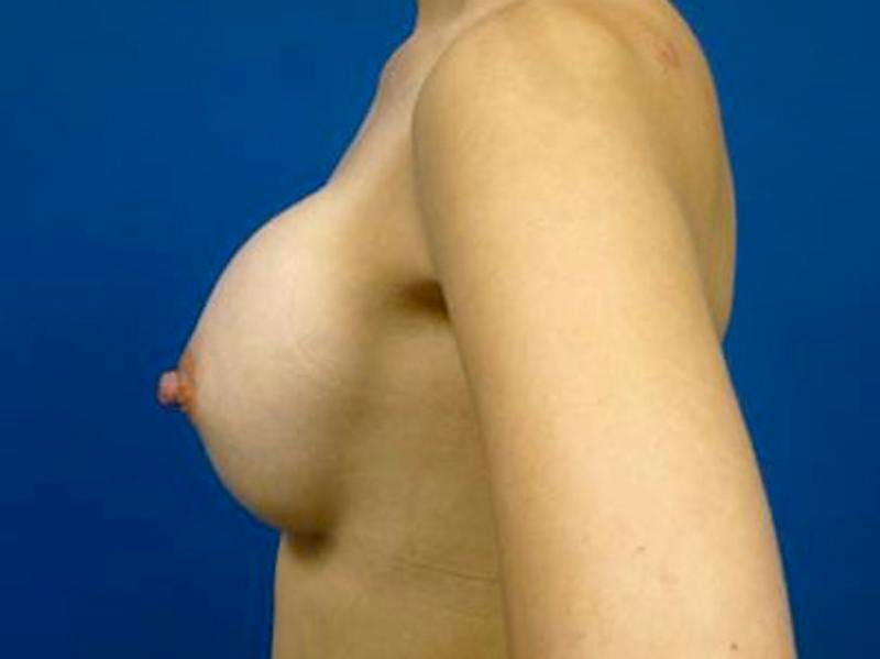 Breast Augmentation Before & After Gallery - Patient 292658 - Image 4