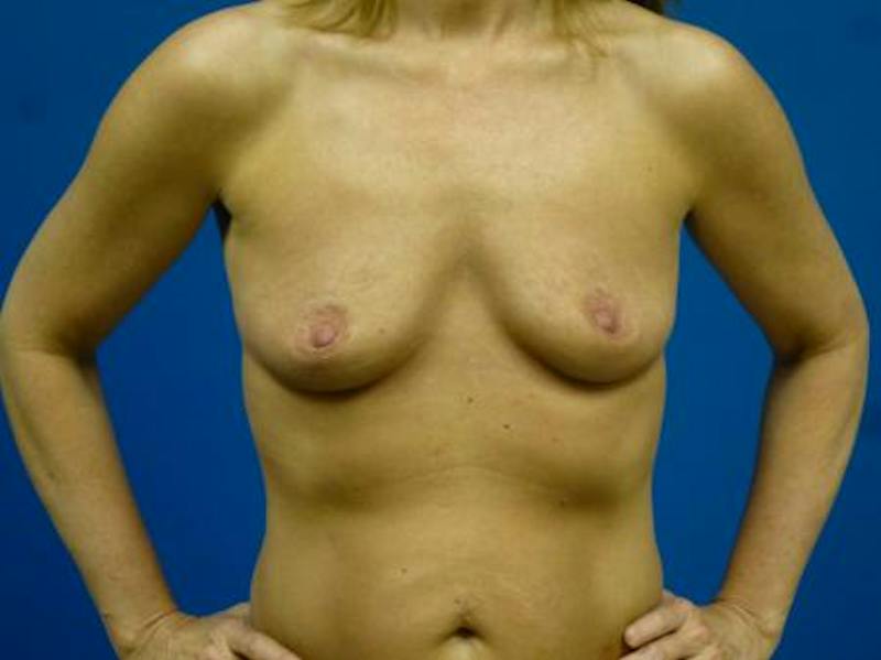 Breast Augmentation Before & After Gallery - Patient 269462 - Image 1