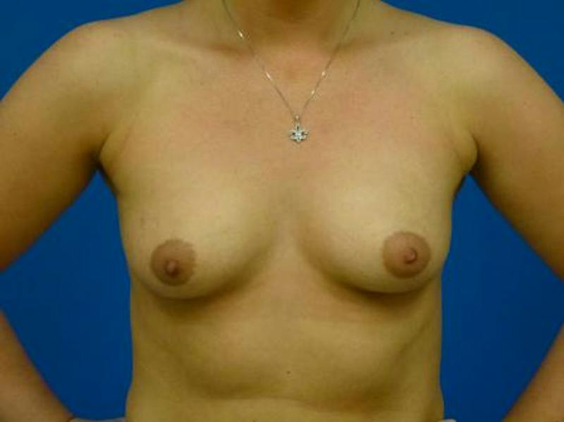 Breast Augmentation Before & After Gallery - Patient 421880 - Image 1
