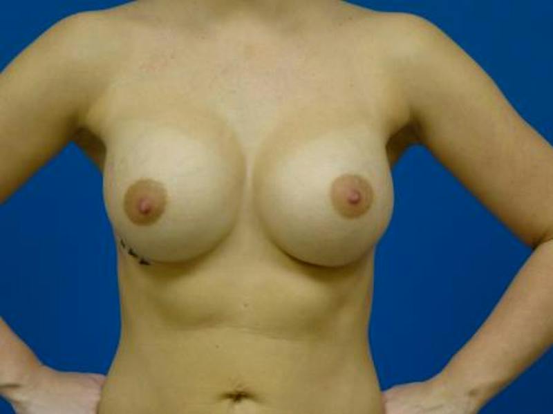 Breast Augmentation Before & After Gallery - Patient 421880 - Image 2