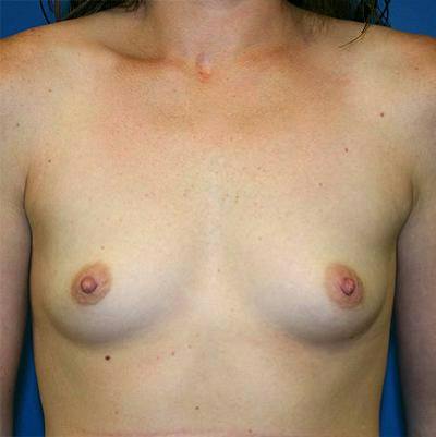 Breast Augmentation Before & After Gallery - Patient 316983 - Image 1