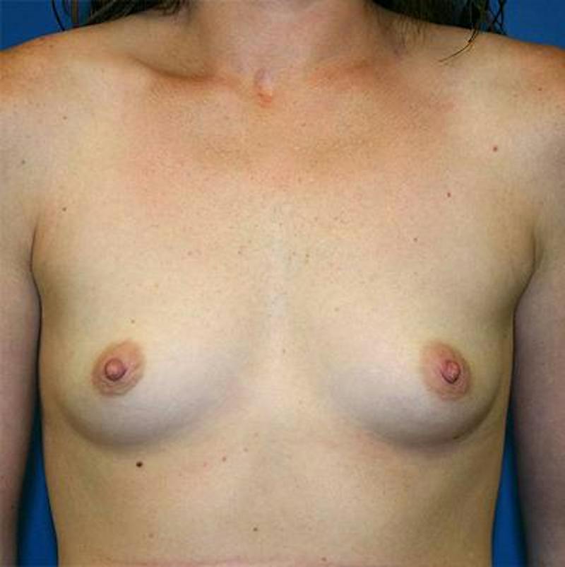 Breast Augmentation Before & After Gallery - Patient 316983 - Image 1