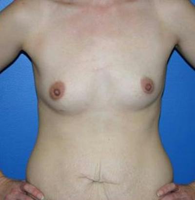 Breast Augmentation Before & After Gallery - Patient 106216 - Image 1