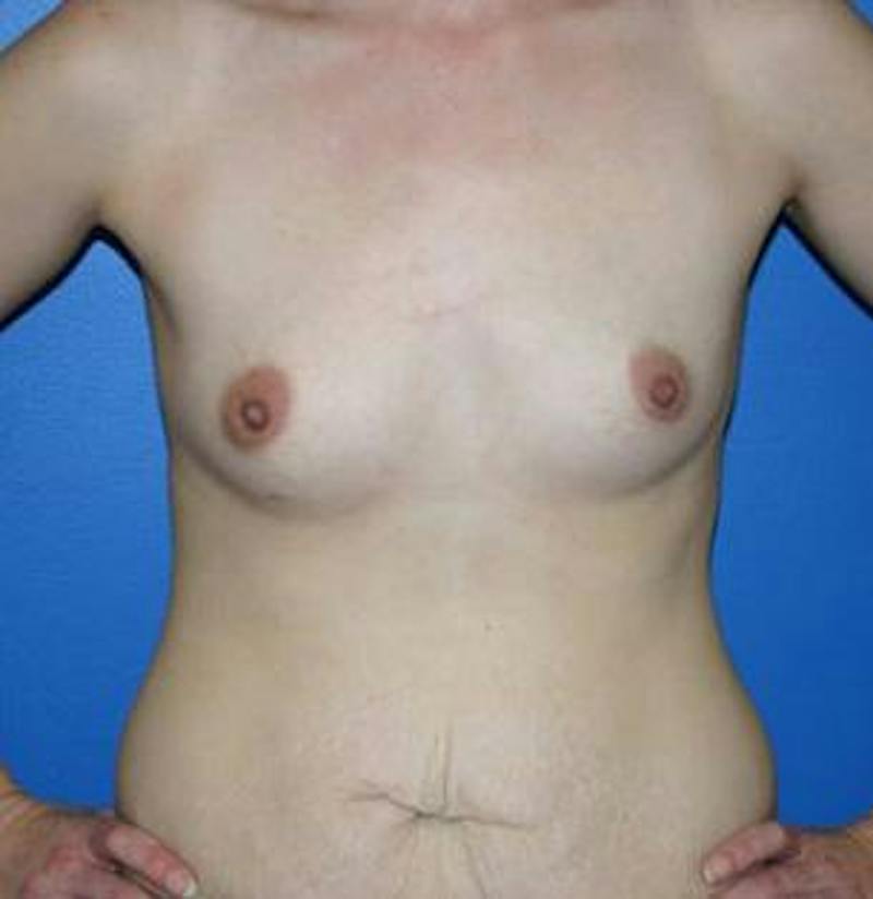 Breast Augmentation Before & After Gallery - Patient 106216 - Image 1
