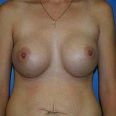 Breast Augmentation Before & After Gallery - Patient 106216 - Image 2