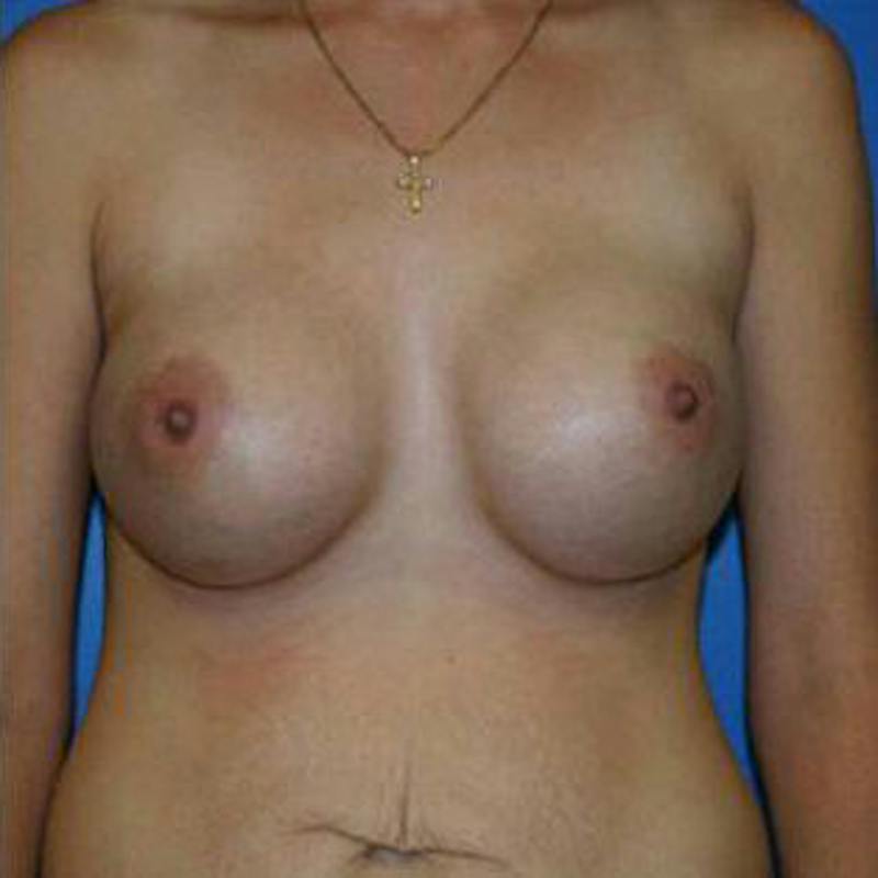 Breast Augmentation Before & After Gallery - Patient 106216 - Image 2