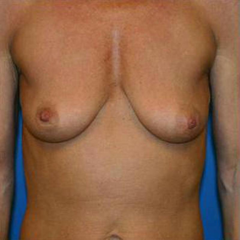 Breast Augmentation Before & After Gallery - Patient 293996 - Image 1