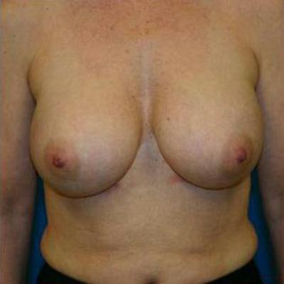 Breast Augmentation Before & After Gallery - Patient 293996 - Image 2