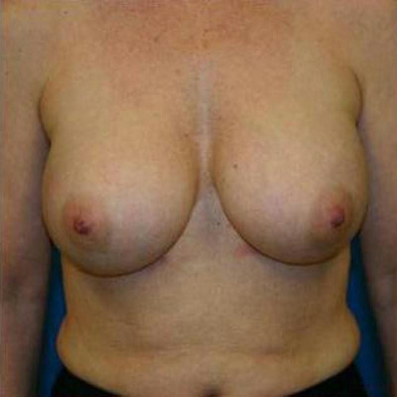 Breast Augmentation Before & After Gallery - Patient 293996 - Image 2