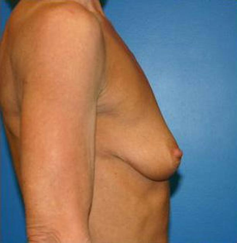 Breast Augmentation Before & After Gallery - Patient 293996 - Image 3
