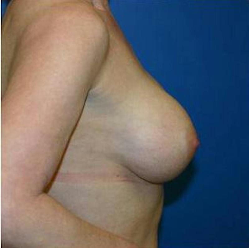Breast Augmentation Before & After Gallery - Patient 293996 - Image 4