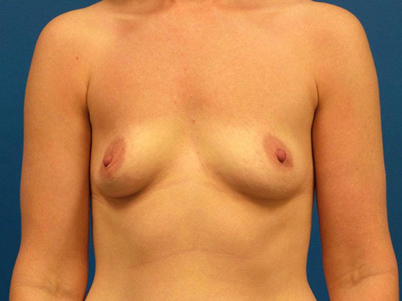 Breast Augmentation Before & After Gallery - Patient 135239 - Image 1