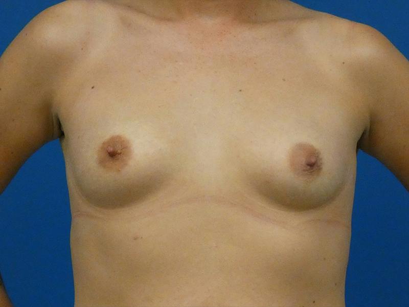 Breast Augmentation Before & After Gallery - Patient 788825 - Image 1