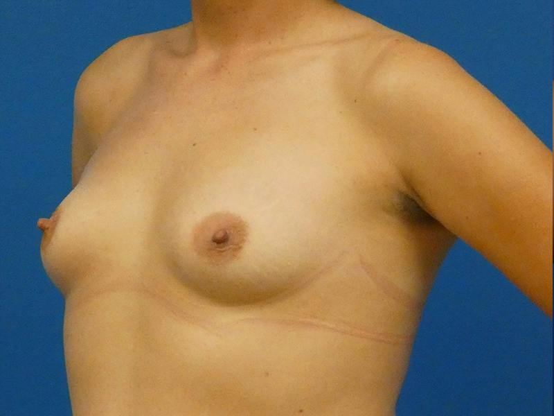Breast Augmentation Before & After Gallery - Patient 788825 - Image 3