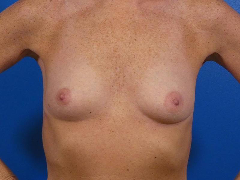Breast Augmentation Before & After Gallery - Patient 111755 - Image 1