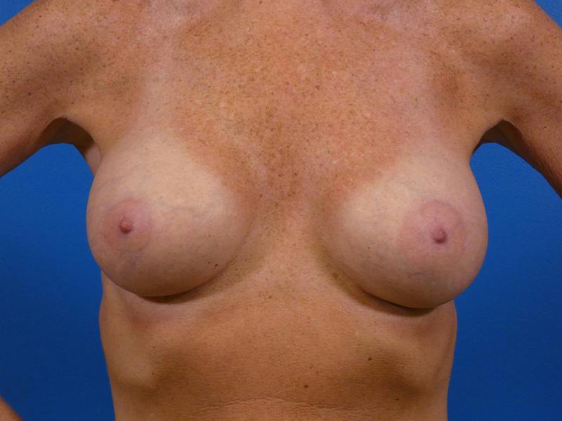 Breast Augmentation Before & After Gallery - Patient 111755 - Image 2