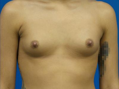 Breast Augmentation Before & After Gallery - Patient 117332 - Image 1