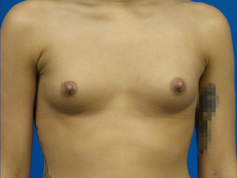 Breast Augmentation Before & After Gallery - Patient 117332 - Image 1