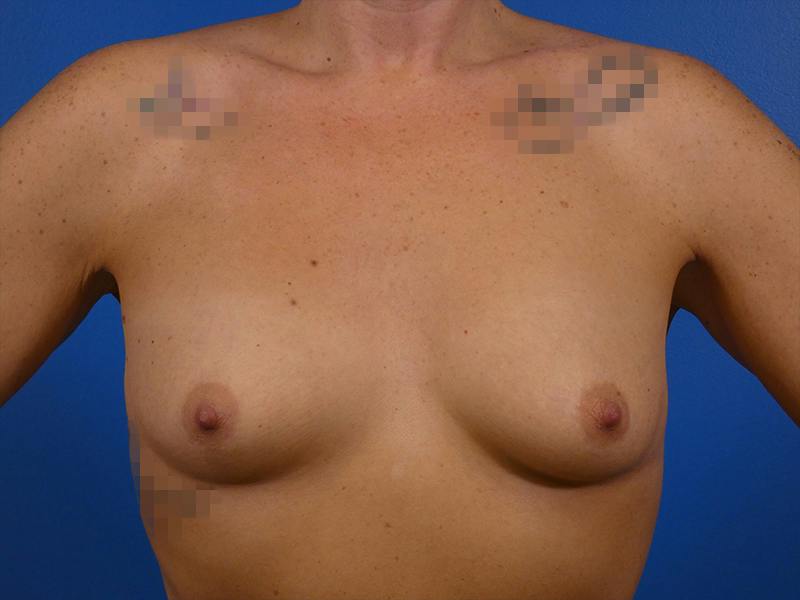 Breast Augmentation Before & After Gallery - Patient 251880 - Image 1