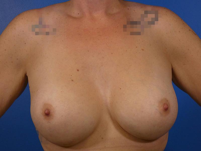 Breast Augmentation Before & After Gallery - Patient 251880 - Image 2