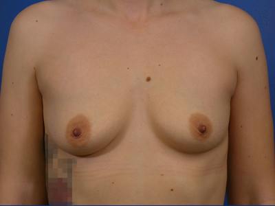 Breast Augmentation Before & After Gallery - Patient 491410 - Image 1