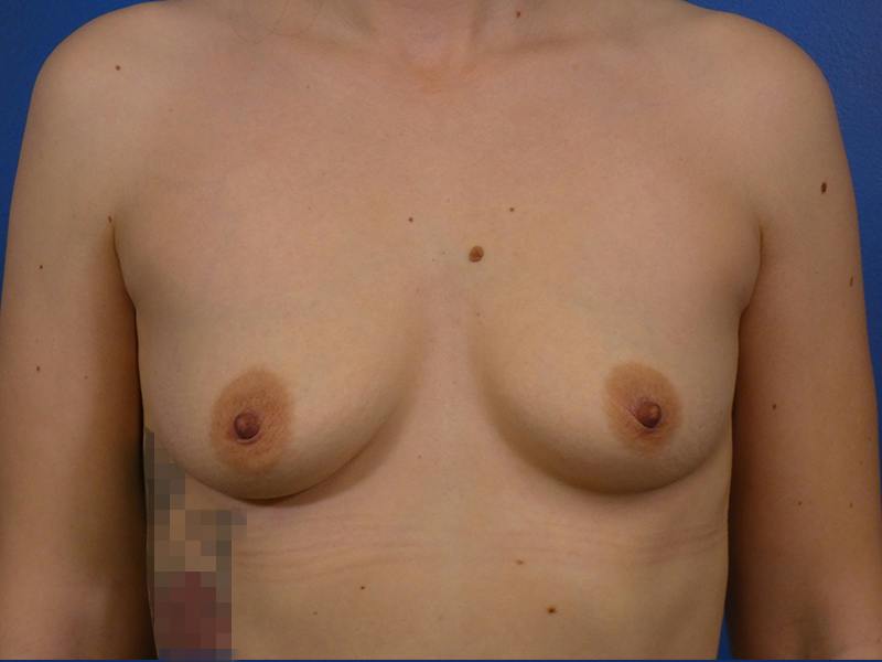 Breast Augmentation Before & After Gallery - Patient 491410 - Image 1