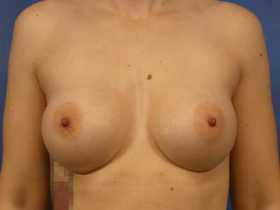 Breast Augmentation Before & After Gallery - Patient 491410 - Image 2
