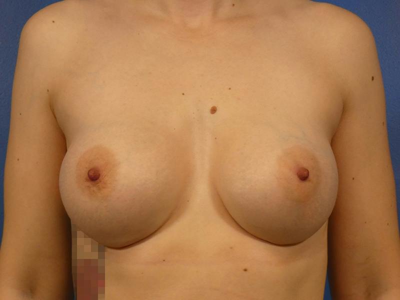 Breast Augmentation Before & After Gallery - Patient 491410 - Image 2