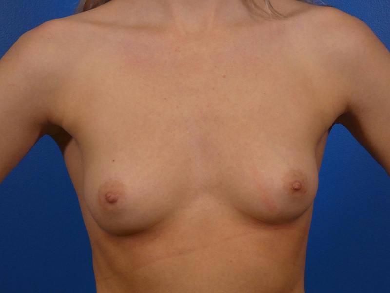 Breast Augmentation Before & After Gallery - Patient 257405 - Image 1
