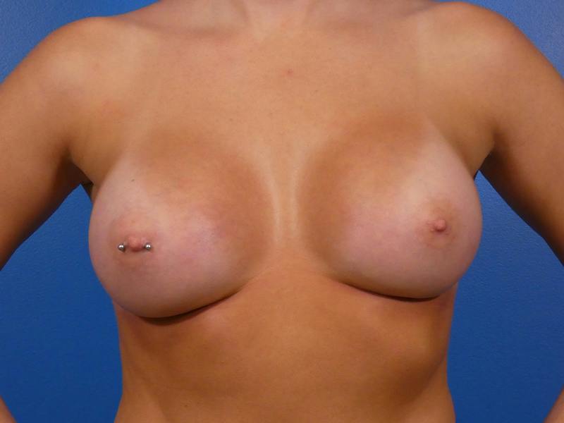 Breast Augmentation Before & After Gallery - Patient 257405 - Image 2