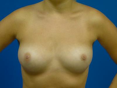Breast Augmentation Before & After Gallery - Patient 405454 - Image 1