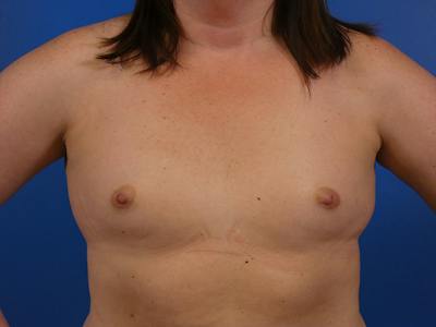 Breast Augmentation Before & After Gallery - Patient 148166 - Image 1