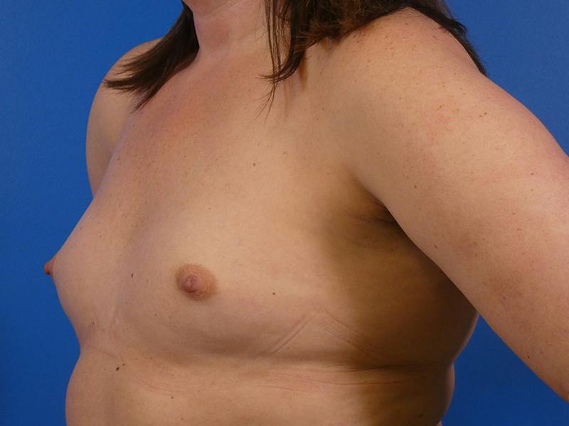 Breast Augmentation Before & After Gallery - Patient 148166 - Image 3