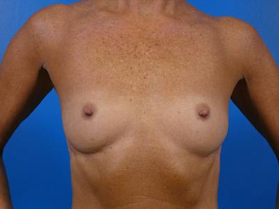 Breast Augmentation Before & After Gallery - Patient 341226 - Image 1