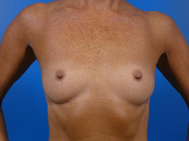 Breast Augmentation Before & After Gallery - Patient 341226 - Image 1