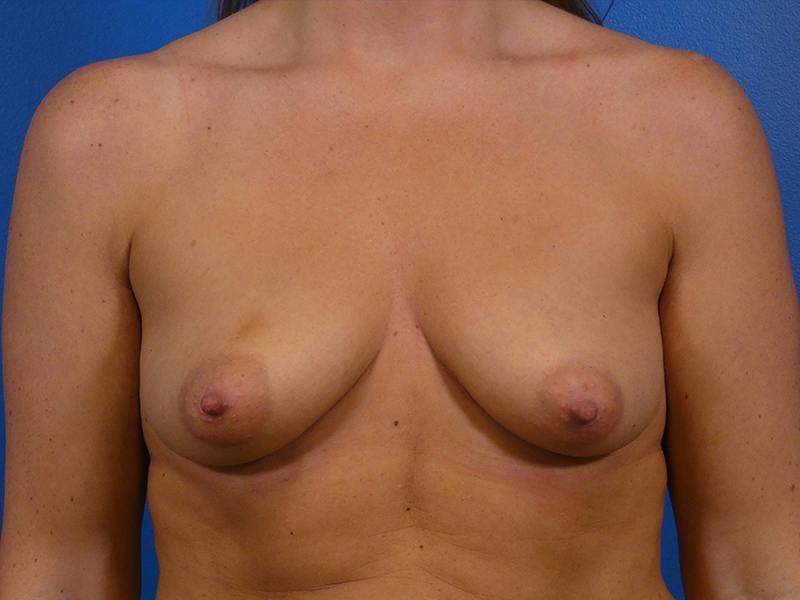 Breast Augmentation Before & After Gallery - Patient 254719 - Image 1