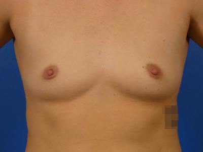 Breast Augmentation Before & After Gallery - Patient 255999 - Image 1