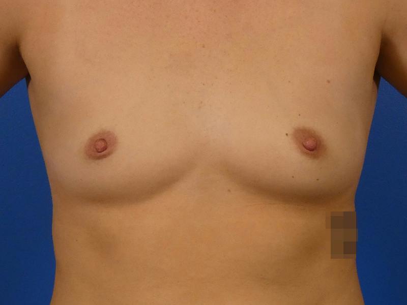 Breast Augmentation Before & After Gallery - Patient 255999 - Image 1