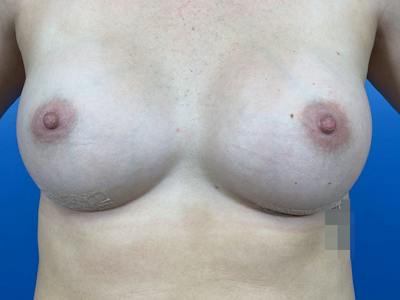 Breast Augmentation Before & After Gallery - Patient 255999 - Image 2