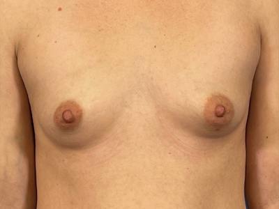 Breast Augmentation Before & After Gallery - Patient 166550 - Image 1