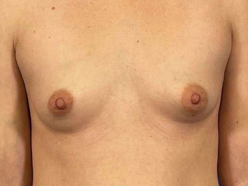 Breast Augmentation Before & After Gallery - Patient 166550 - Image 1