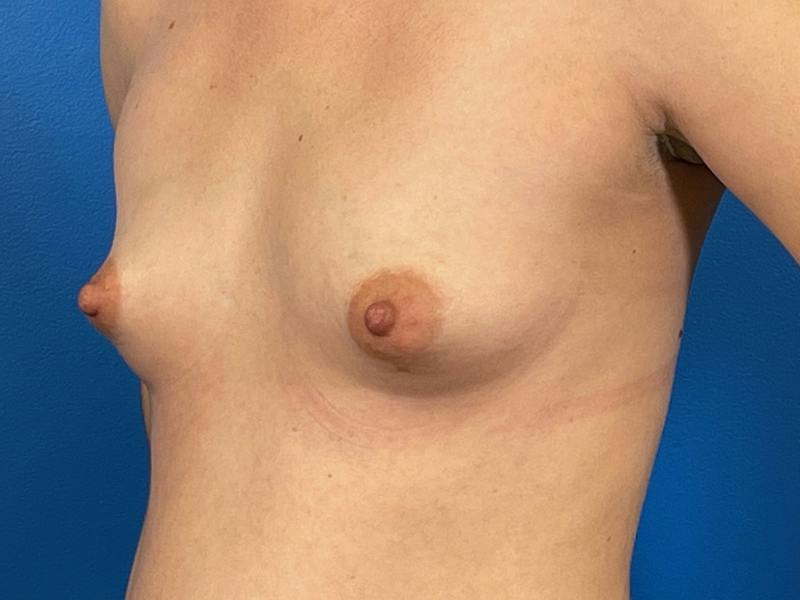 Breast Augmentation Before & After Gallery - Patient 166550 - Image 3