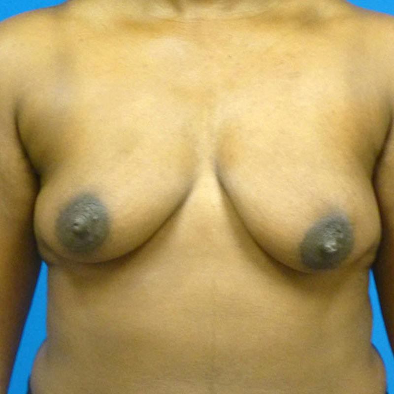 Breast Augmentation With Lift Before & After Gallery - Patient 842327 - Image 1